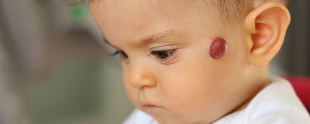 bebê com hemangioma no rosto
