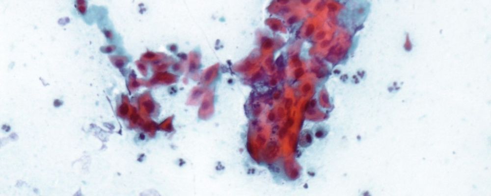 Imagem laboratorial de um carcinoma espinocelular
