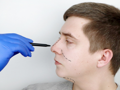 Medico fazendo marcações no nariz do paciente