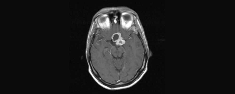 imagem de um raio-x de um cérebro com craniofaringioma