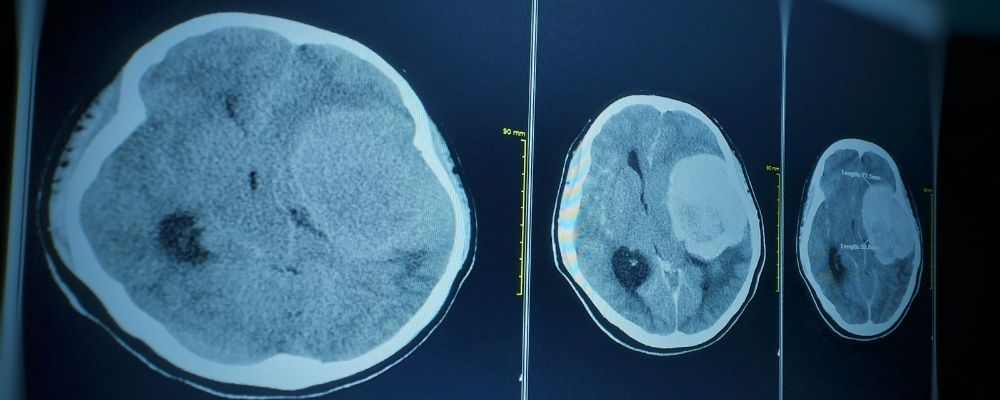 imagens de raio x de um possível meningioma