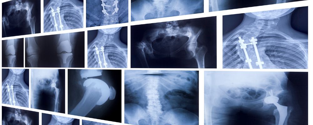 Imagens de raio-x para detectar displasia fibrosa