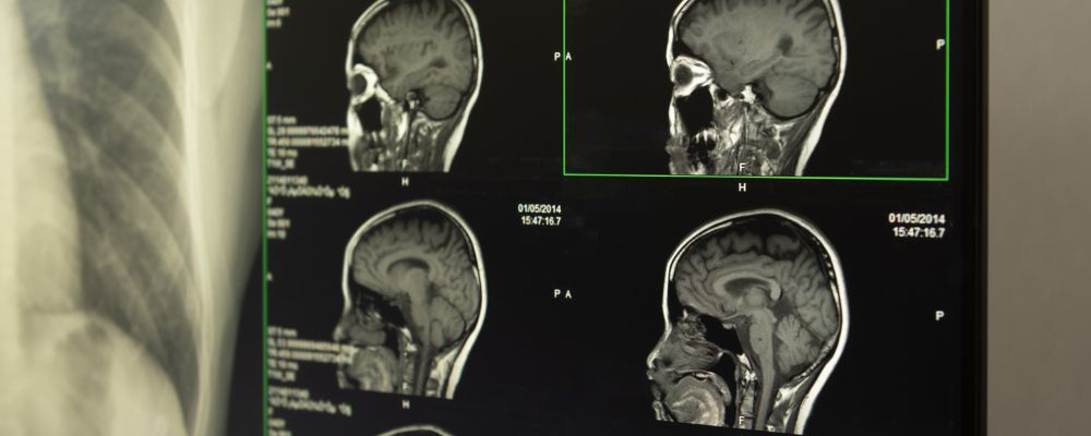 Imagens de raio x tentando detectar fístula liquórica